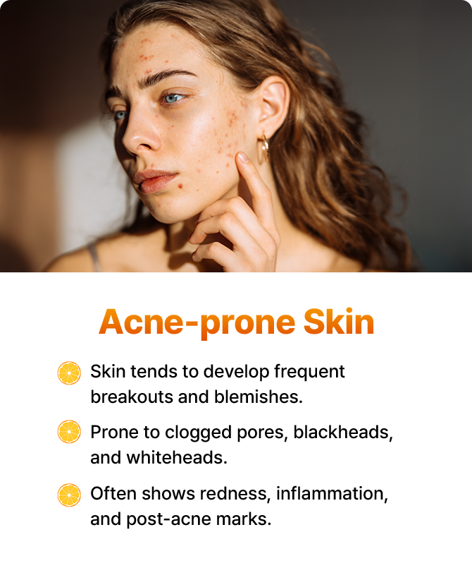 Skin tends to develop frequent breakouts and blemishes. Prone to clogged pores, blackheads, and whiteheads. Often shows redness, inflammation, and post-acne marks.